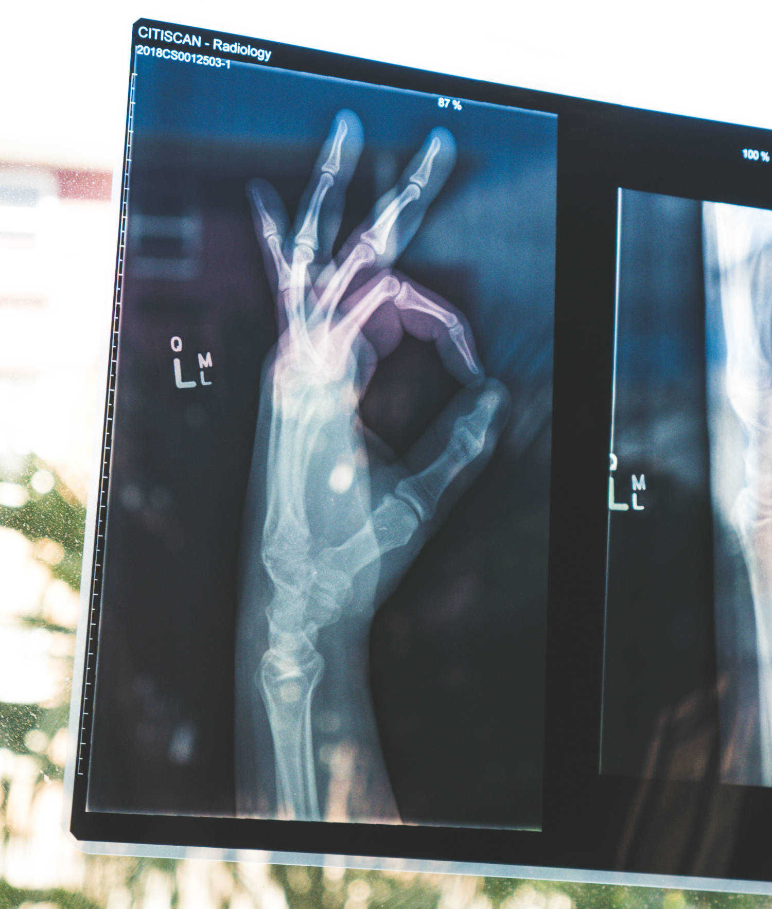 An x-ray image of a hand making an ok sign.